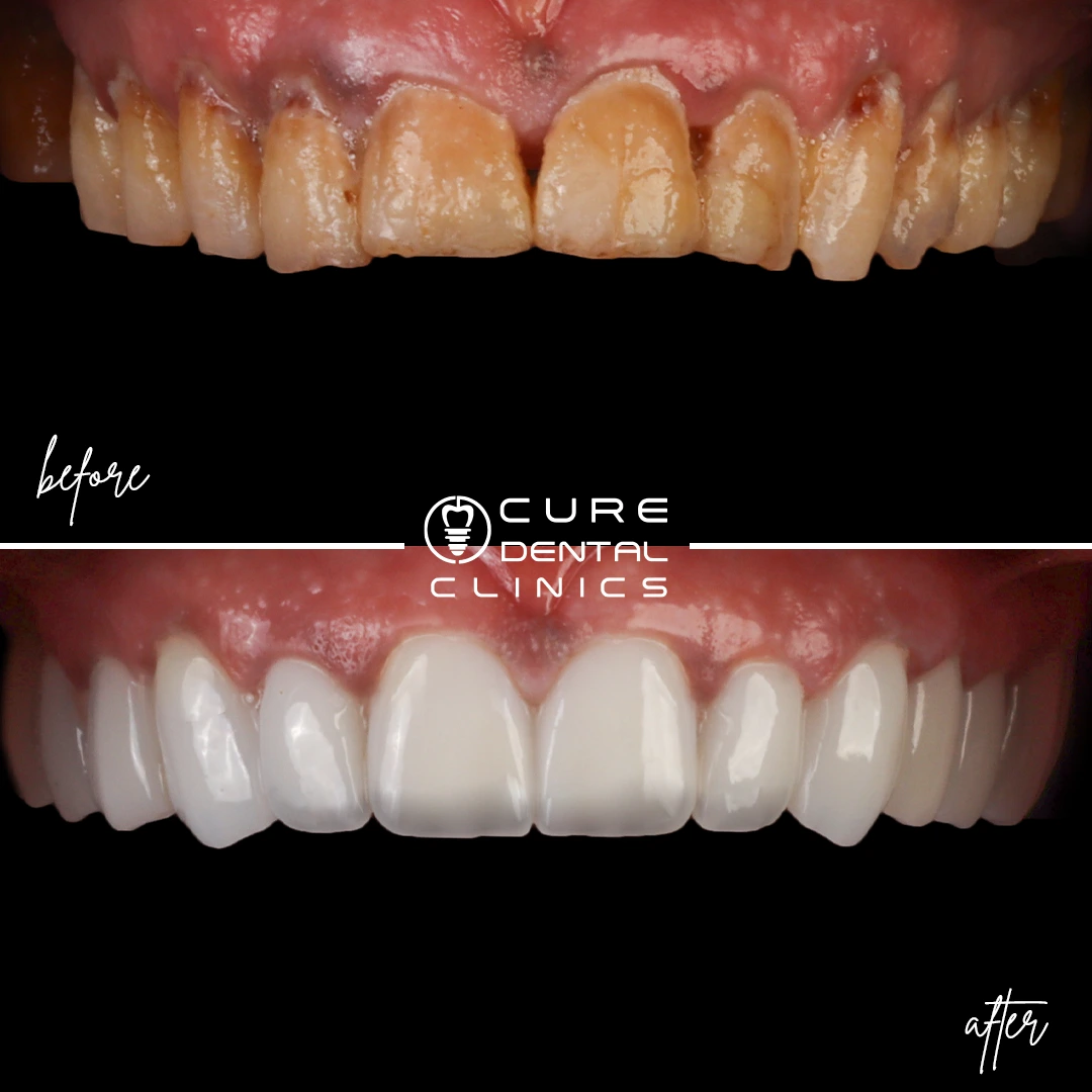 فينير الأسنان جديد