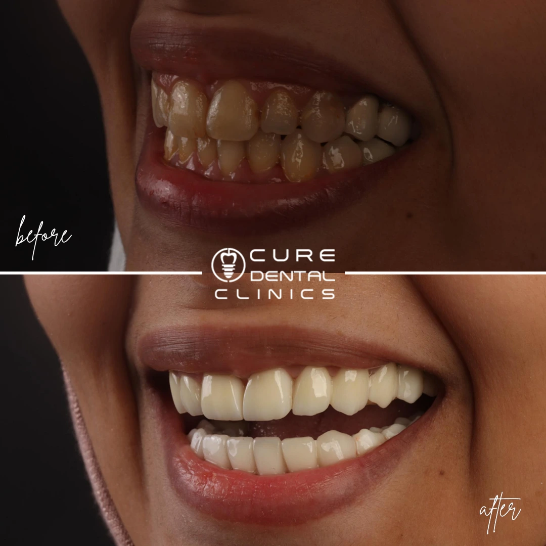 فينير الأسنان كيور