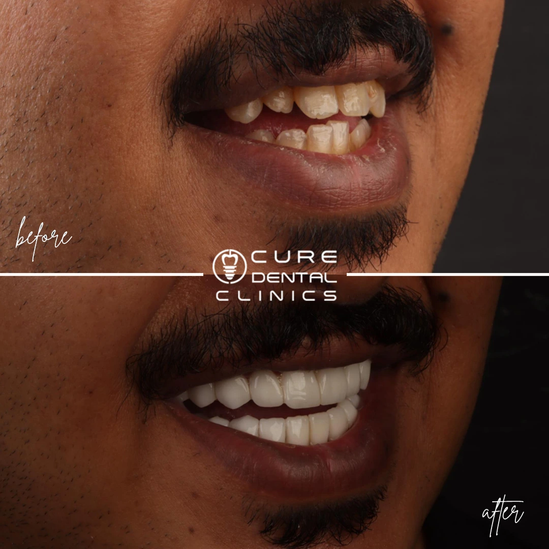 فينير البورسلين