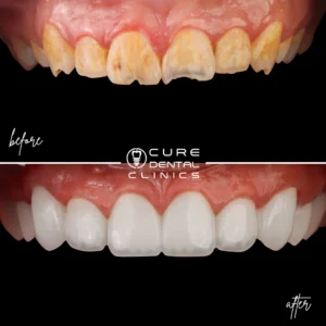 فينير بورسلين