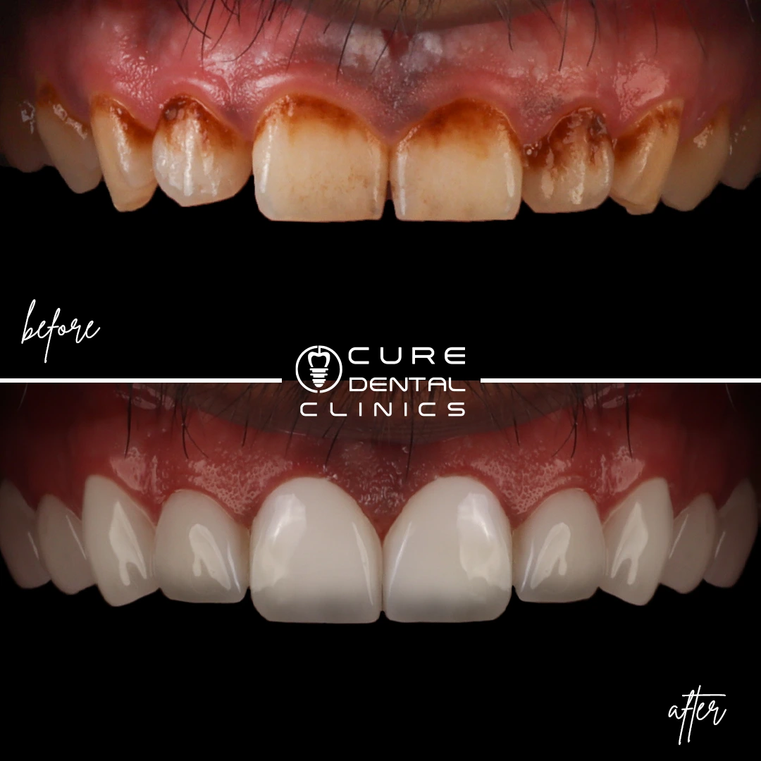 فينير زيركونيوم