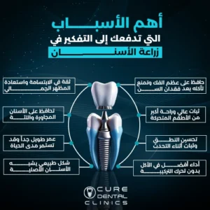 مميزات زراعة الاسنان و اسباب زراعة الاسنان