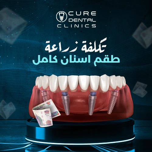 تكلفة زراعة طقم اسنان كامل