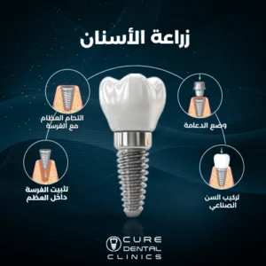 خطوات جراحة زراعة الاسنان
