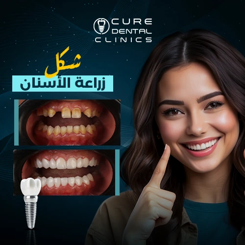 فرق شكل زراعة الاسنان قبل و بعد