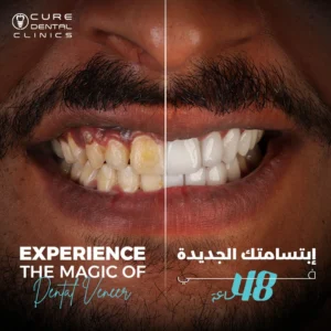 تنظيف الاسنان من الجير