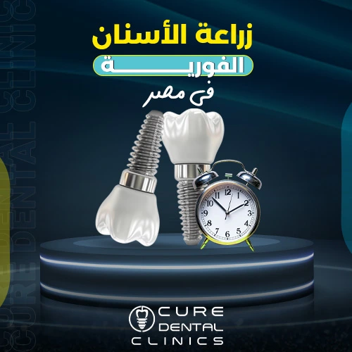 زراعة الاسنان الفورية في مصر