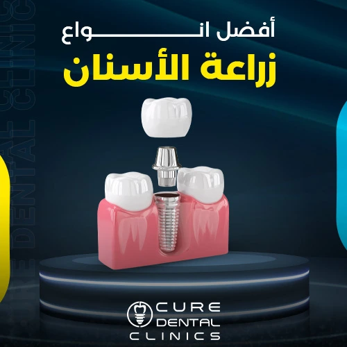 افضل انواع زراعة الاسنان في مصر