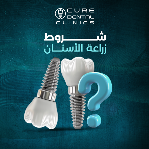 ما الشروط الواجب توافرها في حالات زراعة الأسنان ؟