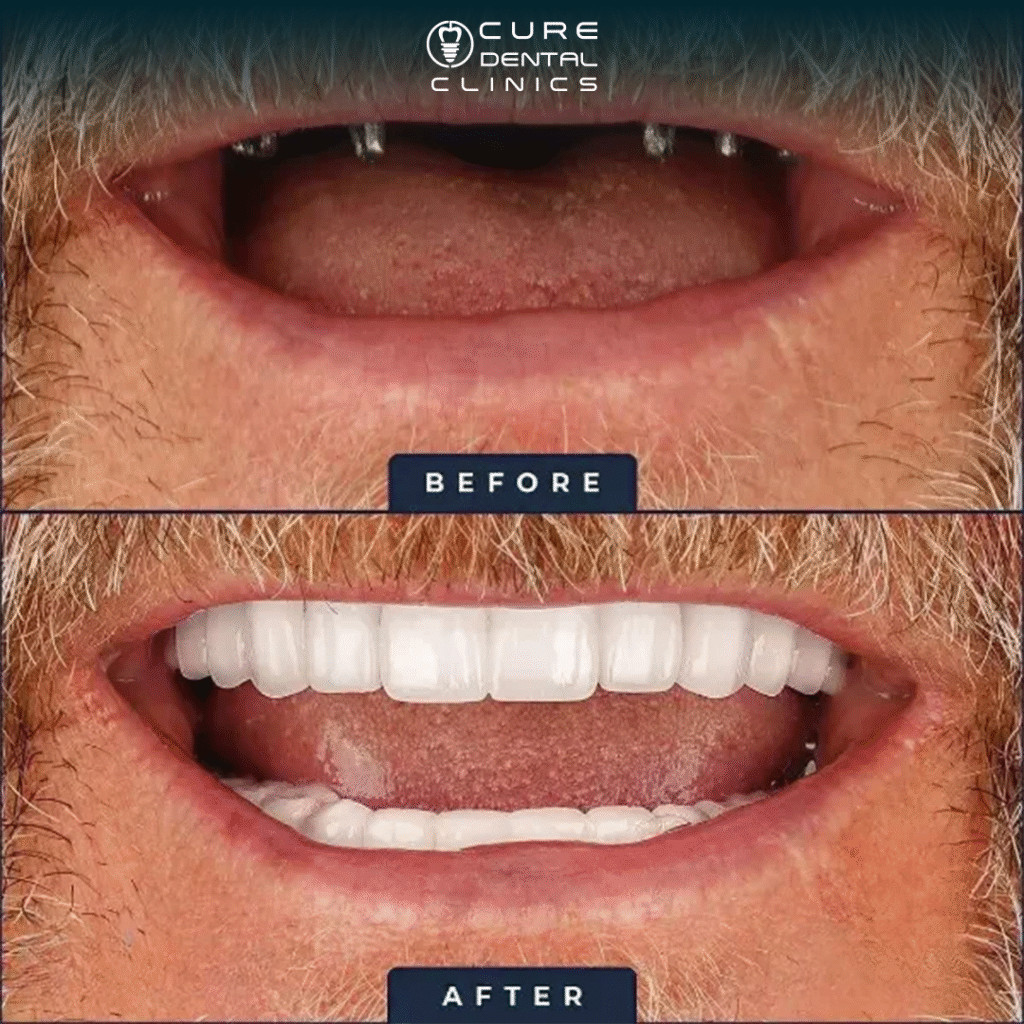 زراعة الاسنان