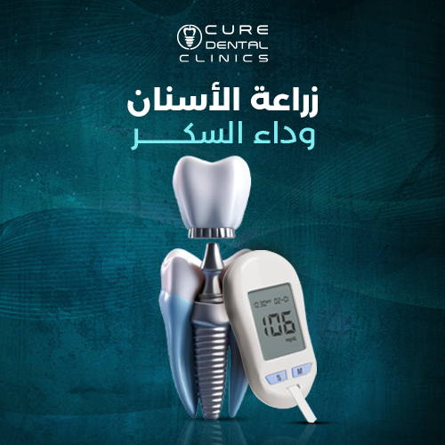 زراعة الأسنان لمرضى السكر