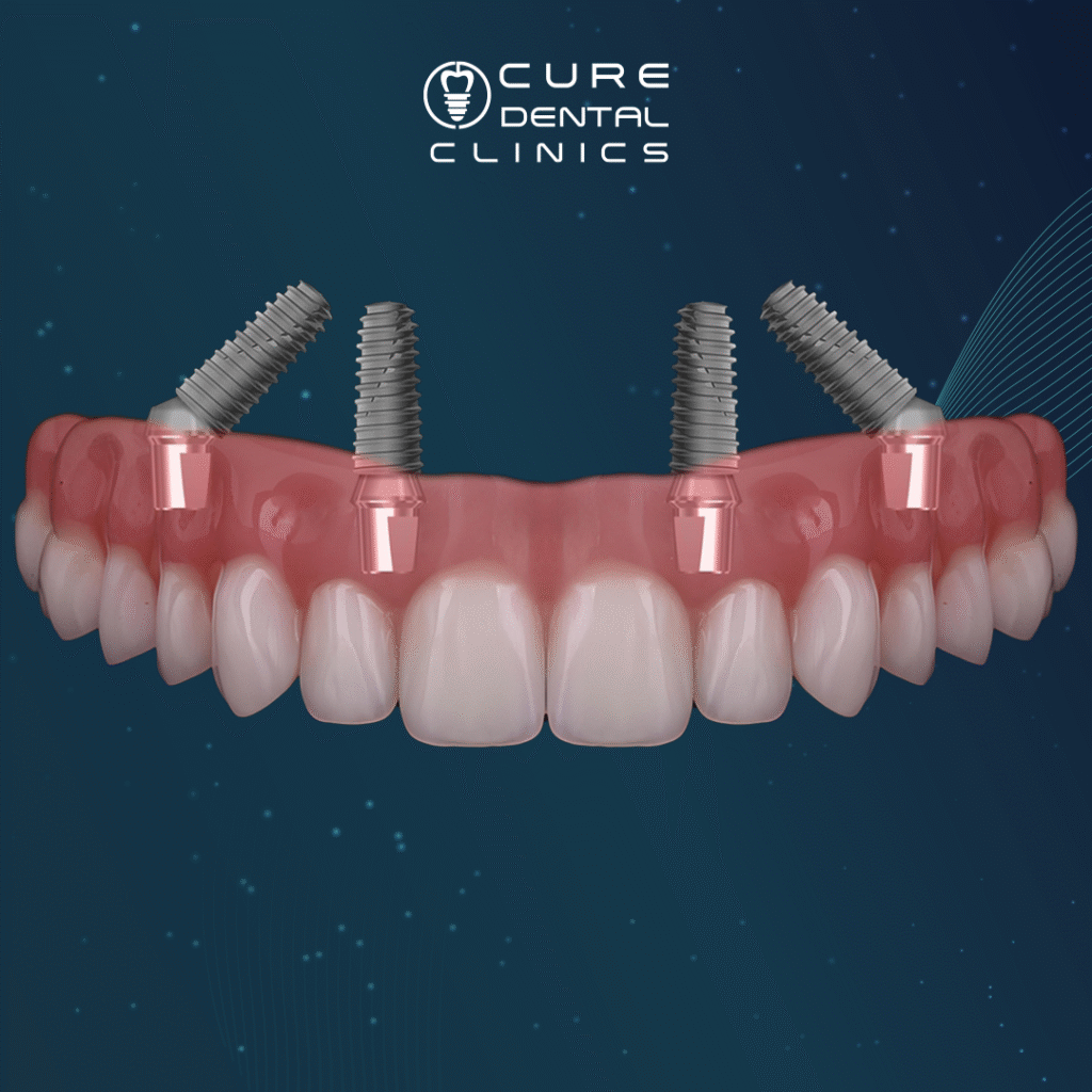 زراعة الاسنان وداء السكري