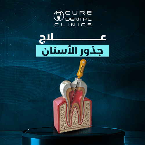 علاج جذور الأسنان