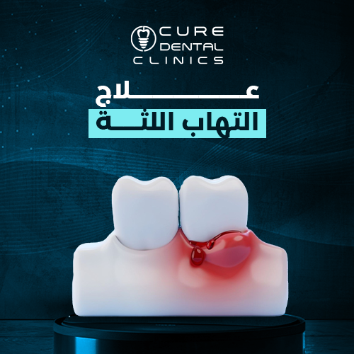 علاج التهاب اللثة