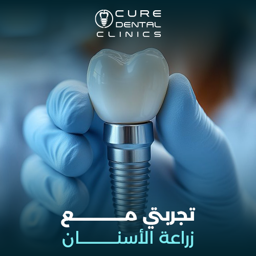 تجربتي مع زراعة الأسنان في مصر