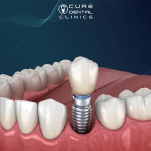 تجربتي مع زراعة الاسنان​
